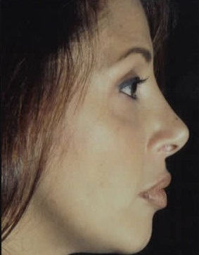 Rhinoplasty. After Treatment Photos - female, right side view, patient 10