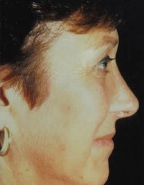 Rhinoplasty. After Treatment Photos - female, right side view, patient 2