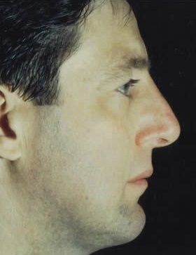 Rhinoplasty. After Treatment Photos - male, right side view, patient 28