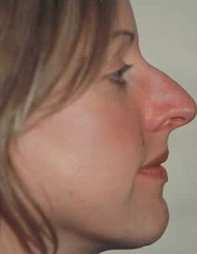 Rhinoplasty. Before Treatment Photos - female, right side view, patient 14