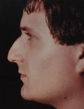 Rhinoplasty. Before Treatment Photos - male, left side view, patient 20