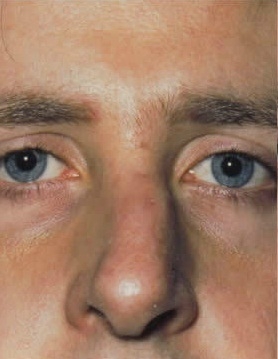 Rhinoplasty. Before Treatment Photos - male, front view, patient 21