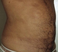 Torsoplasty. Before Treatment Photos - male, right side view, patient 3