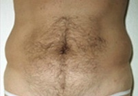 Liposuction Abdomen - Before Treatment Photos - male, front view, patient 4