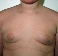 Gynecomastia. Before Treatment Photos - male, front view, patient 6