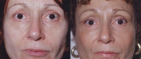 Mid Facelift - Before and After Treatment Photos - female, front view, patient 7
