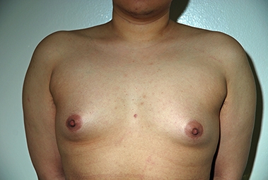 Female to Male Top Surgery. Before Treatment Photos - male, front view, patient 1