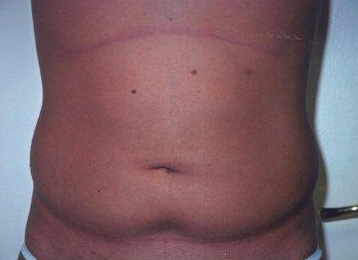 Liposuction Abdomen - Before Treatment Photos - male, front view, patient 5