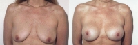 Breast Lift: Before and After Treatment Photos - female, front view, patient 1