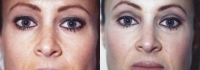 Mid Facelift - Before and After Treatment Photos - female, front view, patient 8
