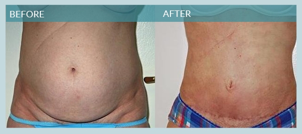 photos before and after mini tummy tuck