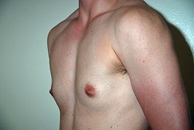 Female to Male Top Surgery. Before Treatment Photos - male, left side oblique view, patient 1