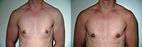 Female to Male Top Surgery. Before and After Treatment Photos - male, front view, patient 1