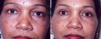 Eyelid Tuck - Before and After Treatment Photos - female, front view, patient 1