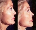 Facelift - Before and After Treatment Photos - female, right side view, patient 1