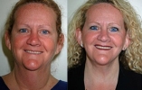Facelift - Before and After Treatment Photos - female, front view, patient 10