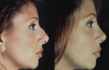 Rhinoplasty. Before and After Treatment Photos - female, right side view, patient 10