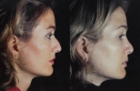 Rhinoplasty. Before and After Treatment Photos - female, right side view, patient 11