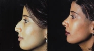Rhinoplasty. Before and After Treatment Photos - female, left side view, patient 1