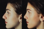 Rhinoplasty. Before and After Treatment Photos - female, left side view, patient 12