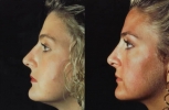 Rhinoplasty. Before and After Treatment Photos - female, left side view, patient 13