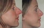 Rhinoplasty. Before and After Treatment Photos - female, right side view, patient 14