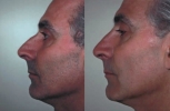 Rhinoplasty. Before and After Treatment Photos - male, left side view, patient 17