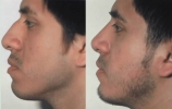 Rhinoplasty. Before and After Treatment Photos - male, left side view, patient 18