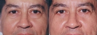 Eyelid Tuck - Before and After Treatment Photos - male, front view, patient 2