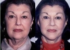 Facelift - Before and After Treatment Photos - female, front view, patient 2