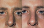 Rhinoplasty. Before and After Treatment Photos - male, front view, patient 21
