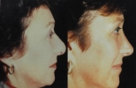 Rhinoplasty. Before and After Treatment Photos - female, right side view, patient 2