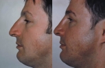 Rhinoplasty. Before and After Treatment Photos - male, left side view, patient 22
