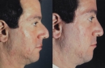 Rhinoplasty. Before and After Treatment Photos - male, right side view, patient 25