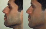 Rhinoplasty. Before and After Treatment Photos - male, left side view, patient 26