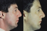 Rhinoplasty. Before and After Treatment Photos - male, right side view, patient 28