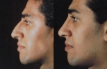 Rhinoplasty. Before and After Treatment Photos - male, left side view, patient 29