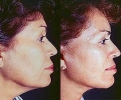 Facelift - Before and After Treatment Photos - female, right side view, patient 3