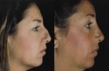 Rhinoplasty. Before and After Treatment Photos - female, right side view, patient 3