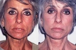 Facelift - Before and After Treatment Photos - female, front view, patient 4