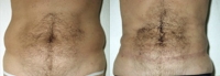 Liposuction Abdomen - Before and After Treatment Photos - male, front view, patient 4