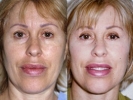Facelift - Before and After Treatment Photos - female, front view, patient 5