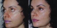 Rhinoplasty. Before and After Treatment Photos - female, left side - oblique view, patient 5