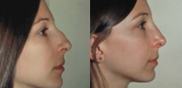 Rhinoplasty. Before and After Treatment Photos - female, right side view, patient 6
