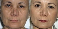 Facelift - Before and After Treatment Photos - female, front view, patient 7