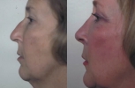 Rhinoplasty. Before and After Treatment Photos - female, left side view, patient 7