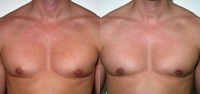 Gynecomastia. Before and After Treatment Photos - male, front view, patient 7