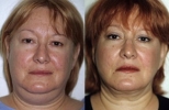 Facelift - Before and After Treatment Photos - female, front view, patient 8