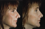 Rhinoplasty. Before and After Treatment Photos - female, right side view, patient 8