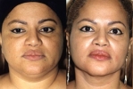 Facelift - Before and After Treatment Photos - female, front view, patient 9